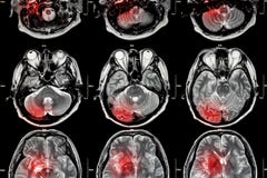 Снимите MRI (магниторезонансное воображение) мозга (хода, опухоли мозга, церебрального инфаркта, интрацеребрального кровотечения) стоковое фото Снимите MRI (магниторезонансное воображение) мозга (хода, опухоли мозга, церебрального инфаркта, интрацеребрального кровотечения) стоковое фото