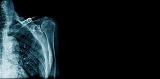 Соединение плеча рентгеновского снимка знамени иллюстрация штока Соединение плеча рентгеновского снимка знамени иллюстрация штока