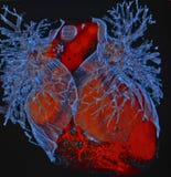 Человеческое сердце, компьютерная томография, CT, радиология стоковое фото rf Человеческое сердце, компьютерная томография, CT, радиология стоковое фото rf