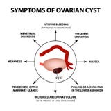 卵巢囊肿卵巢结构的症状 Infographics 在被隔绝的背景的传染媒介例证 向量例证 卵巢囊肿卵巢结构的症状 Infographics 在被隔绝的背景的传染媒介例证 向量例证