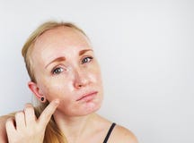 油腻和问题皮肤 一个白肤金发的女孩的画象有粉刺、油性皮肤和染色的 图库摄影 油腻和问题皮肤 一个白肤金发的女孩的画象有粉刺、油性皮肤和染色的 图库摄影