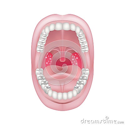 Acute Tonsillitis And Pharyngitis. Bloating And Redness Of The Mendals ...