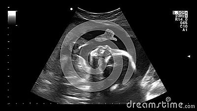 Echographie De Femme Enceinte Gros Plan Du Processus D Examen Par Ultrasons Du Medecin Verifie Le Bebe Dans La Femme Enceinte Banque De Videos Video Du Maternite Diagnostique
