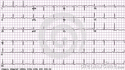 12-lead Electrocardiogram Vector Illustration