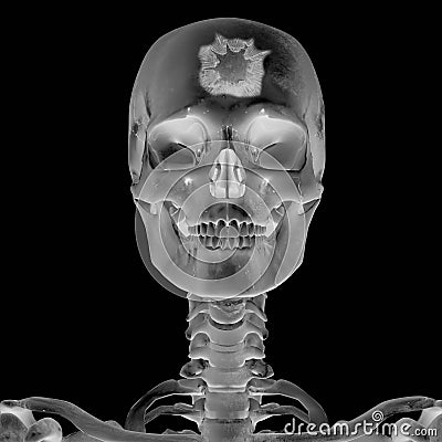 3D Radiograph with head injury Stock Photo