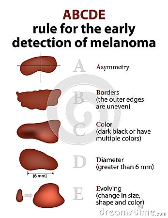 The ABCD rules of Skin Cancer Vector Illustration