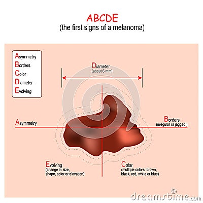 ABCDE. Melanoma. signs and Symptoms of Skin Cancer Vector Illustration