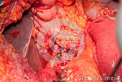Abdomen arteries and veins with pancreas Stock Photo