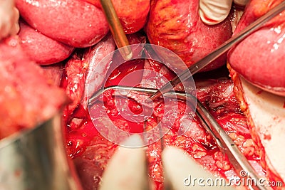 Abdomen arteries and veins with vascular clamp Stock Photo