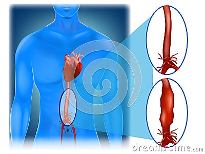 Abdominal aortic aneurysm Vector Illustration