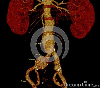 Abdominal aortic infrarenal iliac artery aneurysm aneurysmata Stock Photo