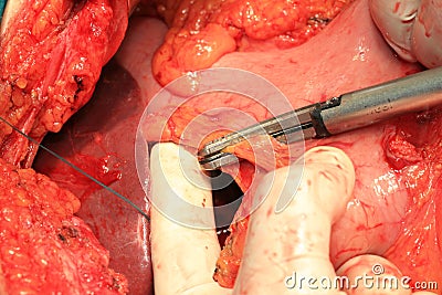 Abdominal arteries and veins Stock Photo