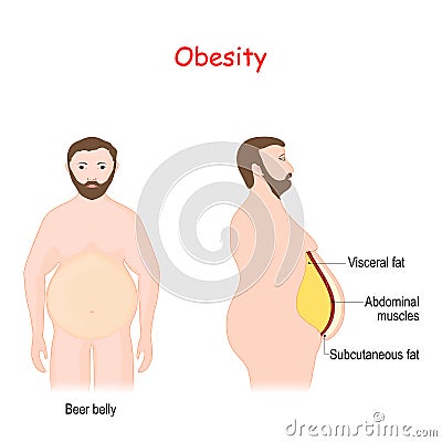 Abdominal obesity. Visceral and subcutaneous fat Vector Illustration