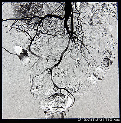 Abdominal and pelvic angiography, vessels Stock Photo