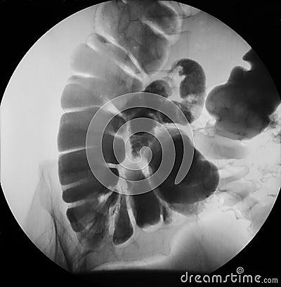 Abdominal x-ray Stock Photo