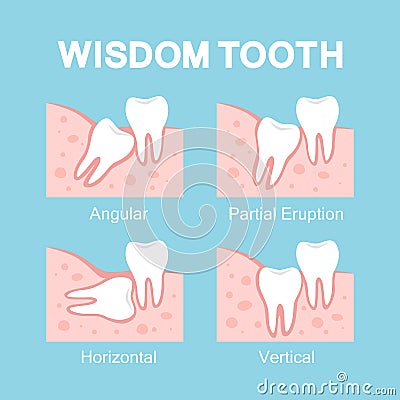 Abnormal eruption of wisdom tooth. Dental problems Vector Illustration