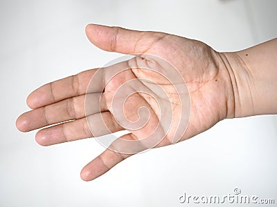 Abnormal finger alignment due to accident Stock Photo