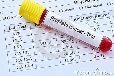 Abnormal high PSA test result Stock Photo