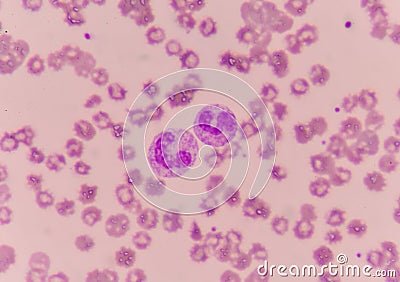 Abnormal neutrophil in blood smear. Stock Photo