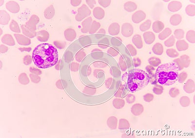 Abnormal neutrophil in blood smear. Stock Photo