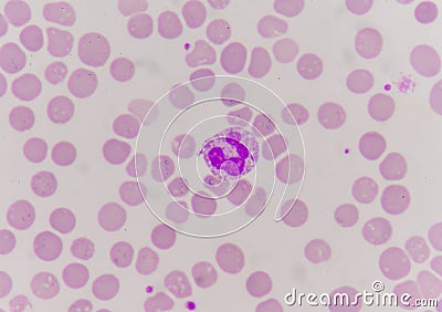 Abnormal neutrophil in blood smear. Stock Photo