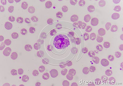 Abnormal neutrophil in blood smear. Stock Photo