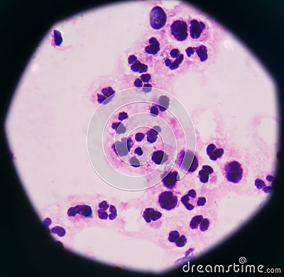 Abnormal neutrophil in pleural fluid smear Stock Photo