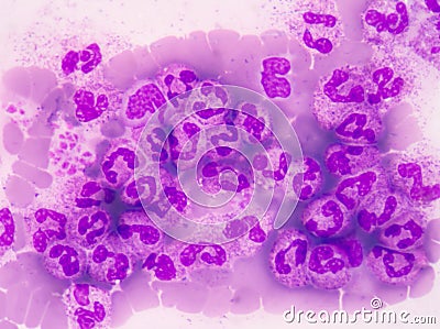 Abnormal neutrophil in pleural fluid smear Stock Photo