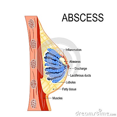 Abscess. Cross-section of the mammary gland with inflammation Vector Illustration