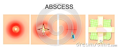 Abscess, furuncle, autopsy, bandage Vector Illustration