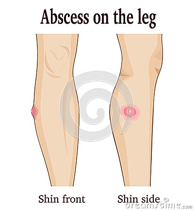 Abscess on the leg Vector Illustration