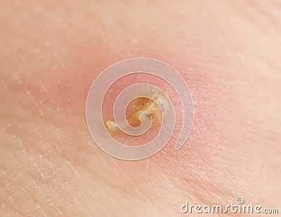 Abscess with pus on the skin Stock Photo