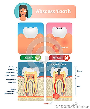 Abscess tooth vector illustration. Labeled medical diagram with structure. Vector Illustration