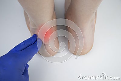 An orthopedic doctor examines a woman`s leg. Achilles tendon and ankle diseases. Inflammation of the heel and foot, Stock Photo