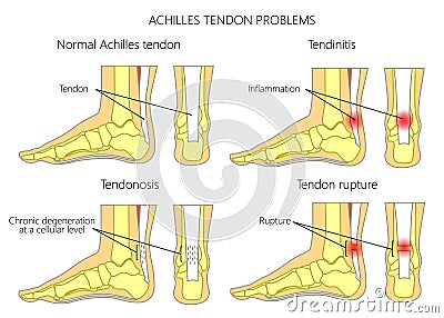 Achilles tendon injures Vector Illustration