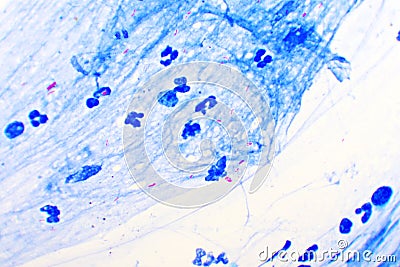 Acid-fast bacilli positive in sputum smear Stock Photo