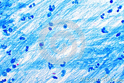 Acid-fast bacilli positive in sputum smear Stock Photo