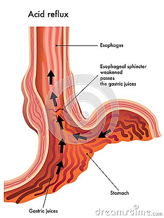 Acid reflux Vector Illustration