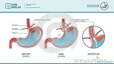Acid reflux and heartburn infographic Vector Illustration
