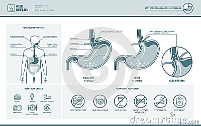 Acid reflux and heartburn infographic Vector Illustration