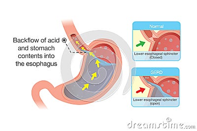 Acid in stomach back up into esophagus Vector Illustration