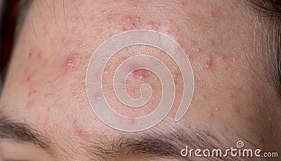 Acne Stock Photo