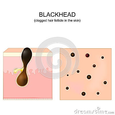 Acne. blackhead. clogged pore. Cross-section of a human skin Vector Illustration