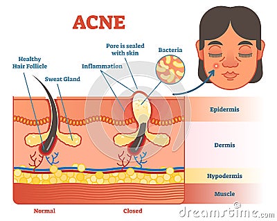 Acne diagram illustration with hair, pimple, skin layers and structure. Female face alongside. Educational medical informat Vector Illustration