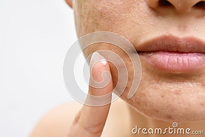 Acne and face skin problem, Woman applying acne cream medication. Stock Photo