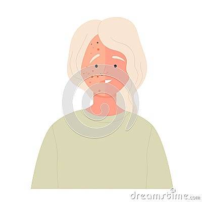 Acne face before and after treatment Vector Illustration