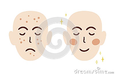 Acne face treatment concept with two different faces before and after. Acne skin problem. Acne scars. Anti acne cosmetic Vector Illustration