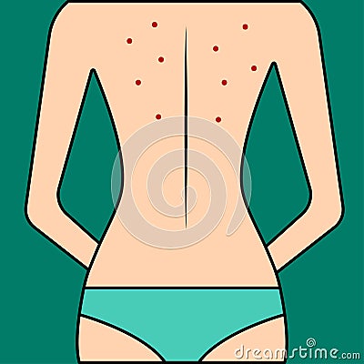 Acne on female back Vector Illustration