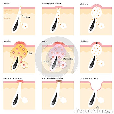 Acne formation process Vector Illustration