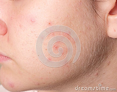 Acne on the girl's face Stock Photo